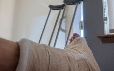 5 cuidados para a recuperação do pé quebrado
